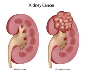 Kidney-Cancer-768x660.jpg.optimal