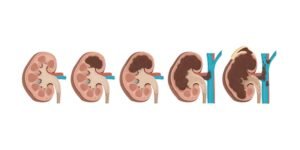 Kidney-Cancer_1